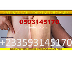 Stretch marks solutions