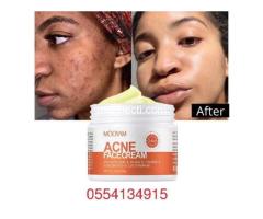 Pimples, Acne Face Cream - 3