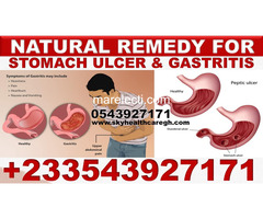 NATURAL ANTIBIOTICS FOR STOMACH ULCER IN GHANA