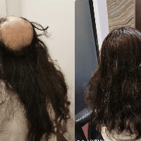 Hair Replacement SG