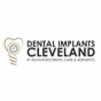 Dental Implants Cleveland